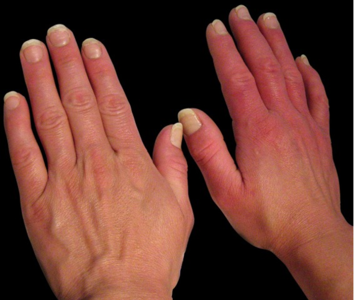 Эритема рук при эритромелалгии