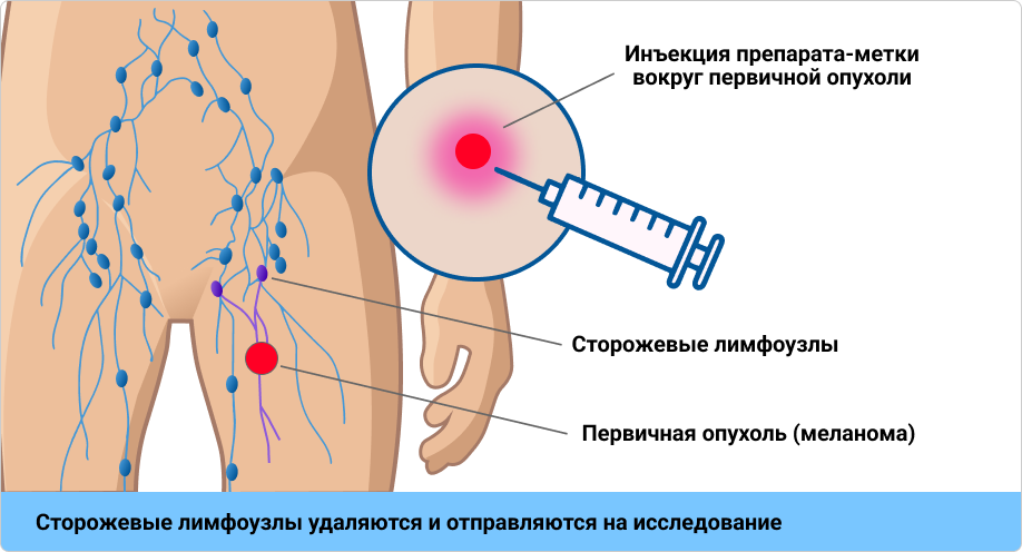 Рисунок 2. Методика проведения БСЛУ.